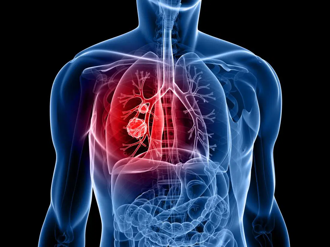 Lung Cancer Awareness and Treatment